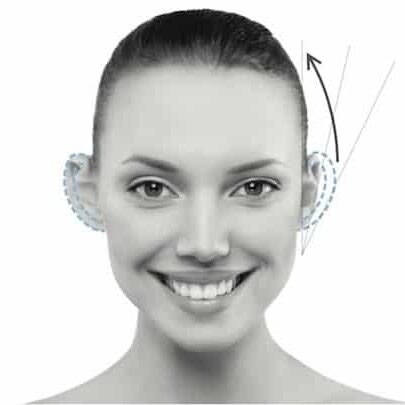 otoplastika